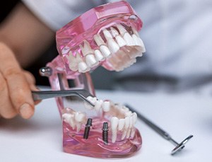 Hand holding dental instrument carefully placing dental bridge over sample implants