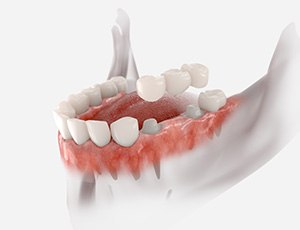 Illustration of a traditional dental bridge