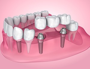 Illustration of an implant bridge