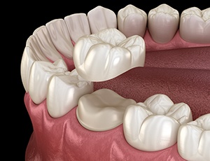 Digital image of a dental crown