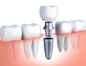 diagram of dental implants in Virginia Beach