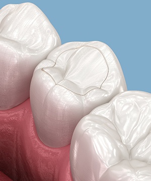 A computer generated drawing of a tooth-colored filling