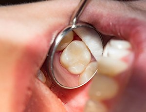 A tooth with a composite resin filling