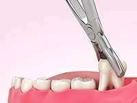A digital image of a tooth being extracted for dental implant placement