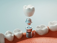 A digital image of a dental implant, metal abutment, and customized crown that will sit on top of the abutment