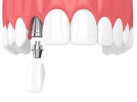 dental implant with abutment and crown being placed in the upper arch