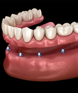 model of all-on-4