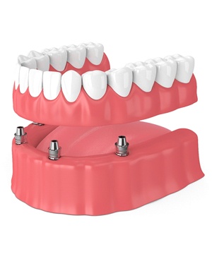 implant-retained denture