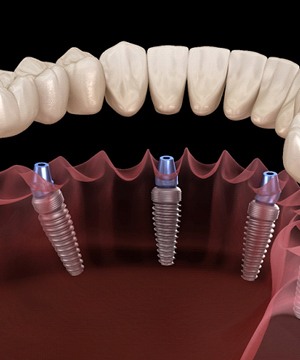 implant denture