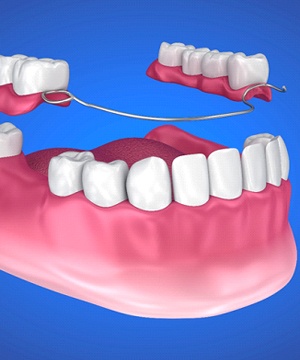 model of partial denture replacing missing teeth
