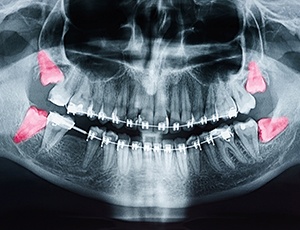 An illustration of wisdom teeth developing in the jaw 