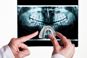 Tooth grinding, or bruxism, causes dental fracture, facial pain and more. Consult dentist in Virginia Beach, Dr. Sarah Esparza, for a simple solution.