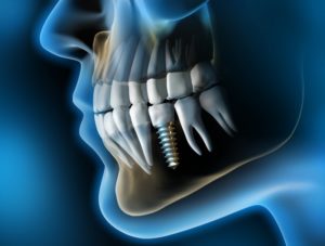 dental implant x-ray