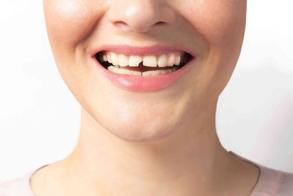 Woman with a broken tooth
